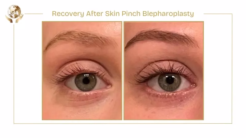 Recovery After Skin Pinch Blepharoplasty