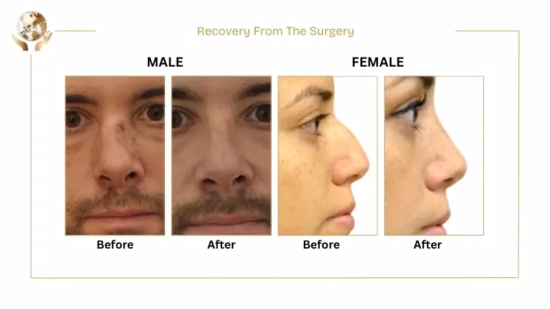 Male Vs Female Nose Rhinoplasty - Differences You Must Know 2 Recovery From The Surgery
