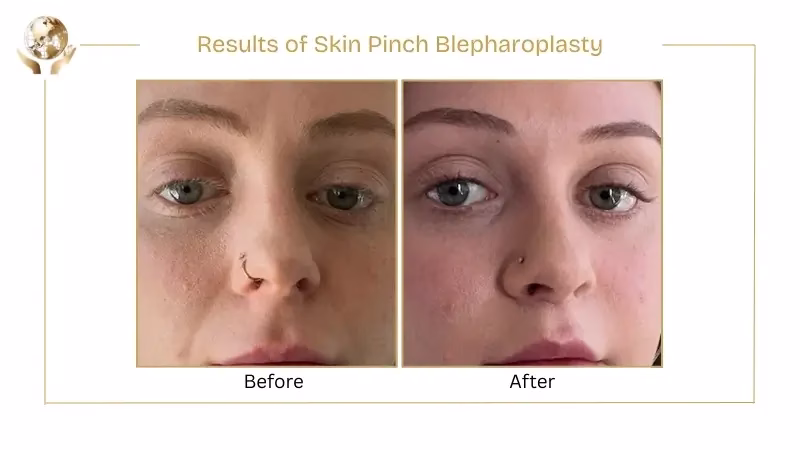 Results of Skin Pinch Blepharoplasty
