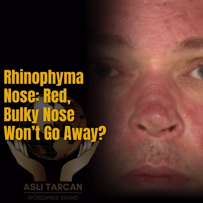 Rhinophyma Nose - Red, Bulky Nose Won’t Go Away