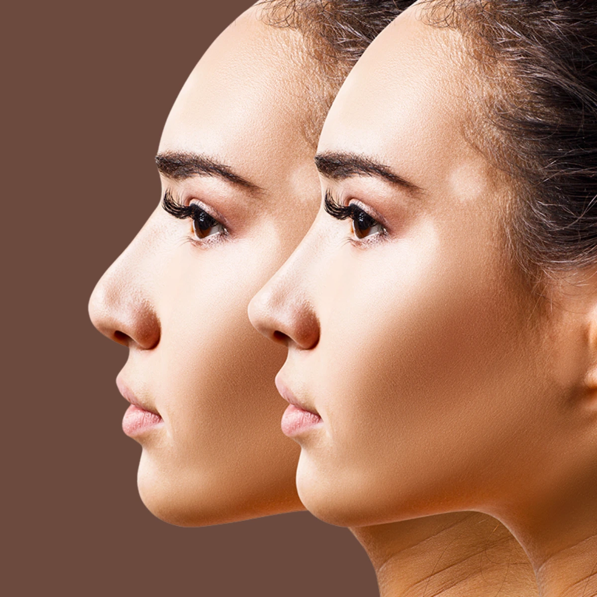 1 Rhinoplasty In Turkey