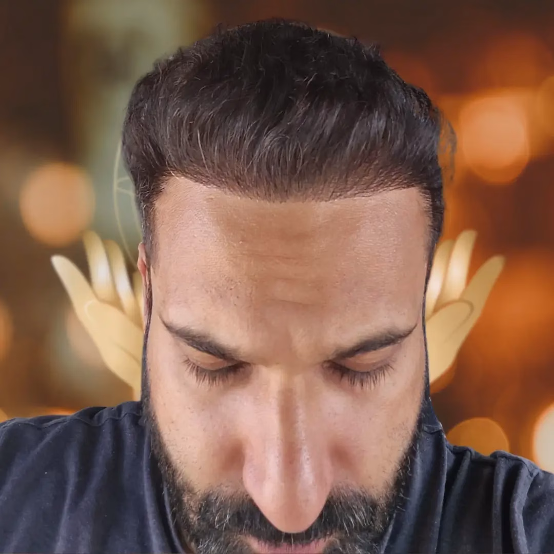 Primer plano de un hombre mirando hacia abajo, mostrando la línea frontal del cabello y resultados estéticos de un procedimiento capilar, con fondo desenfocado y tonos cálidos.