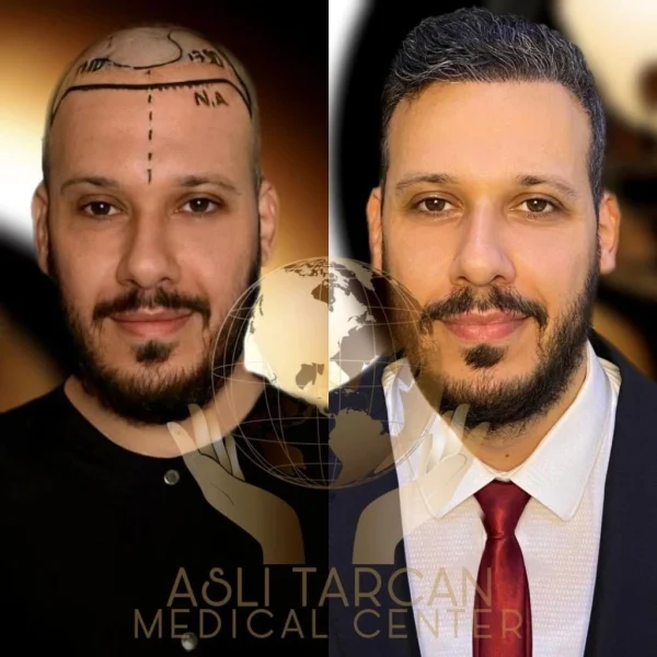 Sapphire FUE Hair Transplant