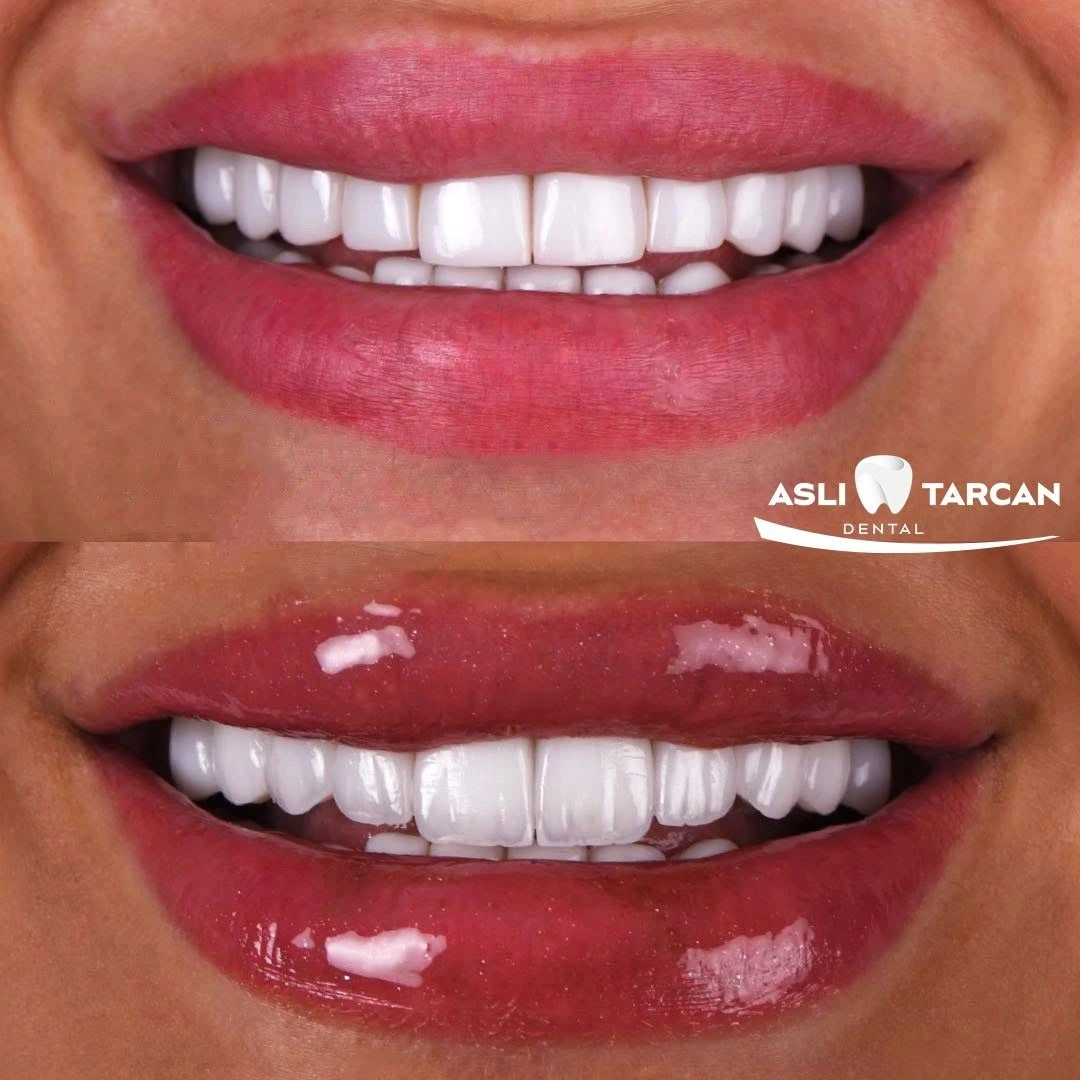 Side Effects of Hollywood Smile Treatment
