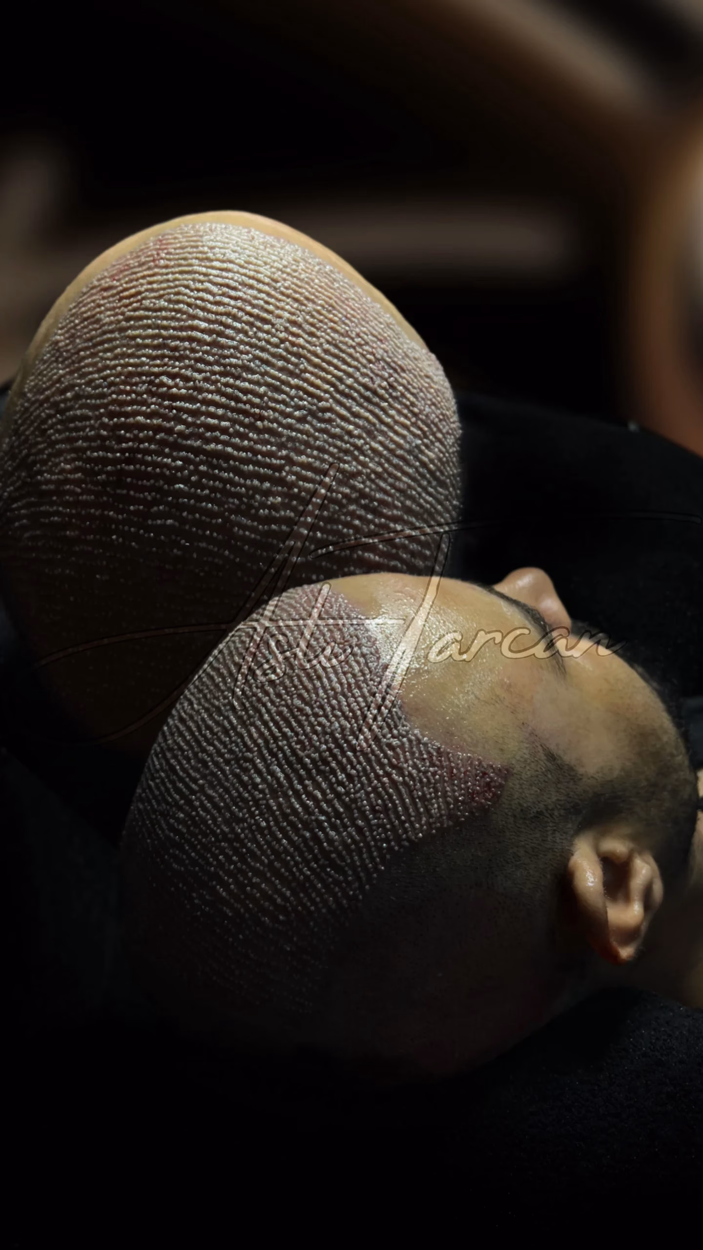 Vista cercana de dos cabezas después de un trasplante capilar, mostrando la zona implantada con cientos de injertos en el cuero cabelludo bajo iluminación clínica.