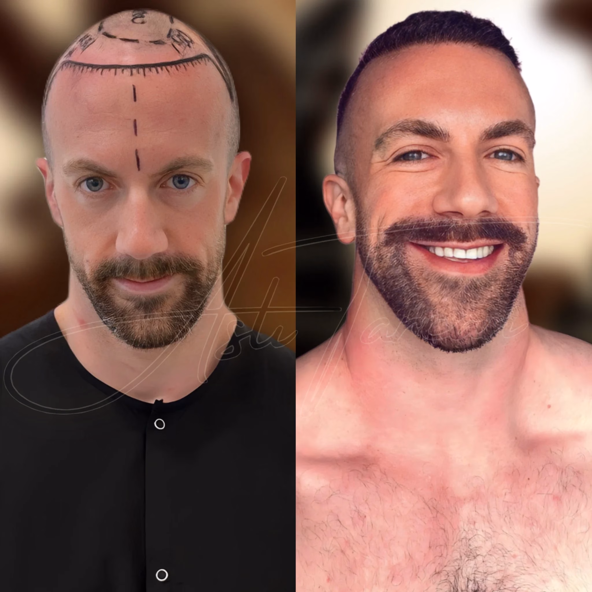 Comparación antes y después de un hombre: cabeza rapada con marcas de trasplante y luego cabello corto y barba con resultado natural, logrado con la Técnica FUE Zafiro.