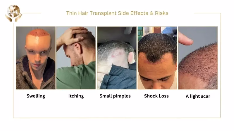 Hair Transplant for Thin Hair: Causes, Procedure & Benefits 6 Thin Hair Transplant Side Effects & Risks