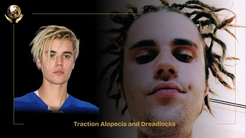 Justin Bieber Hair Transplant