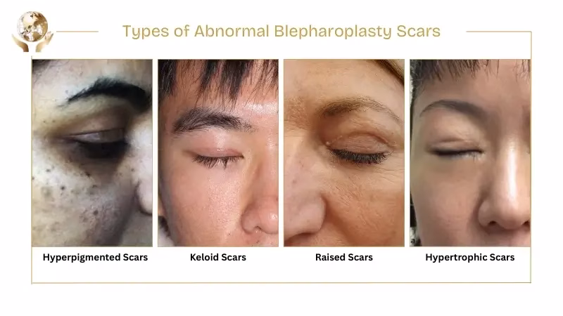 Types of Abnormal Blepharoplasty Scars