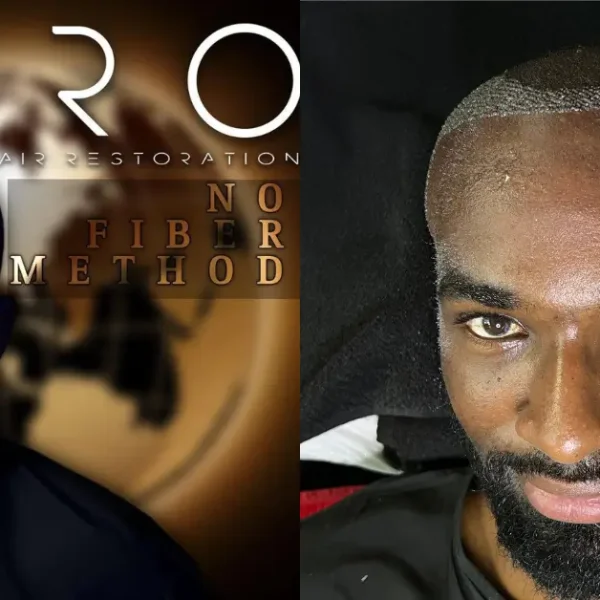 afro hair transplant,Afro Hair Transplant turkey,afro hair transplant in Turkey