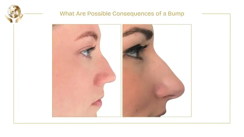 Hit My Nose 5 Days After Rhinoplasty 2 What Are Possible Consequences of a Bump