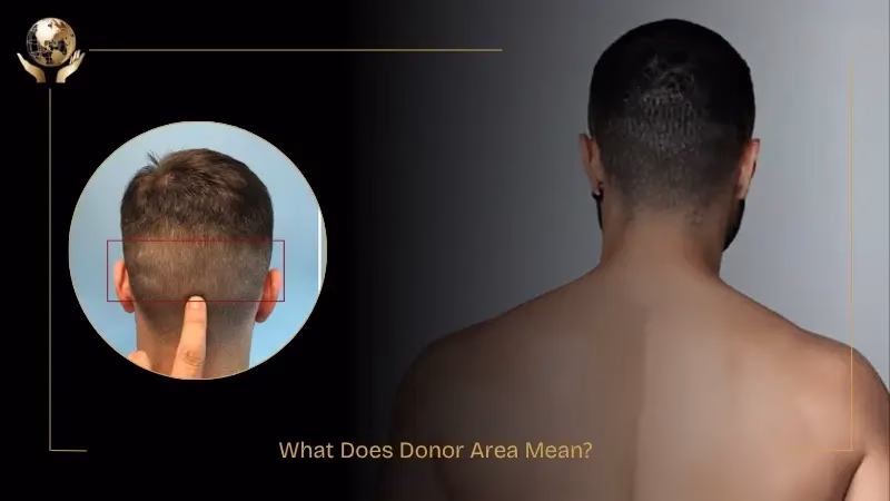 Not Enough Donor Hair For Transplant 1 What Does Donor Area Mean