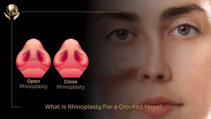 Rhinoplasty For a Crooked Nose: Risks, Procedure, Recovery Guide 1 What Is Rhinoplasty For a Crooked Nose