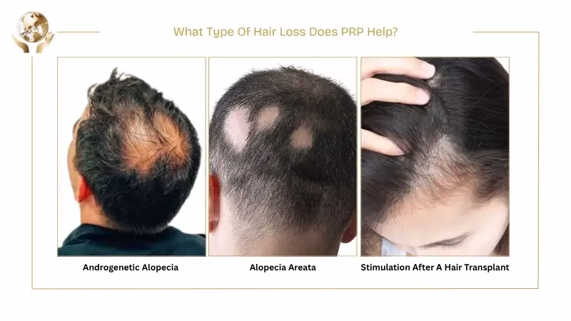Top PRP Hair Treatment Benefits You’ll Notice Within Months 4 What Type Of Hair Loss Does PRP Help