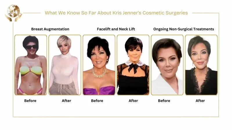 Kris Jenner Face Lift At The Age of 69 In 2025 2 What We Know So Far About Kris Jenner's Cosmetic Surgeries