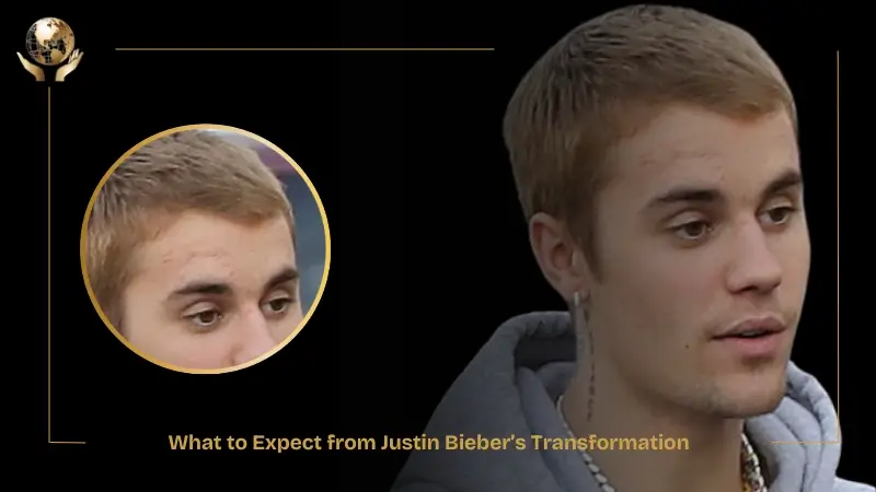 Justin Bieber Hair Transplant