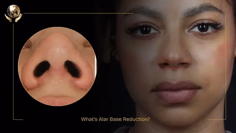 Alar Base Reduction: From Wide Nostrils to Refined Features 1 What’s Alar Base Reduction
