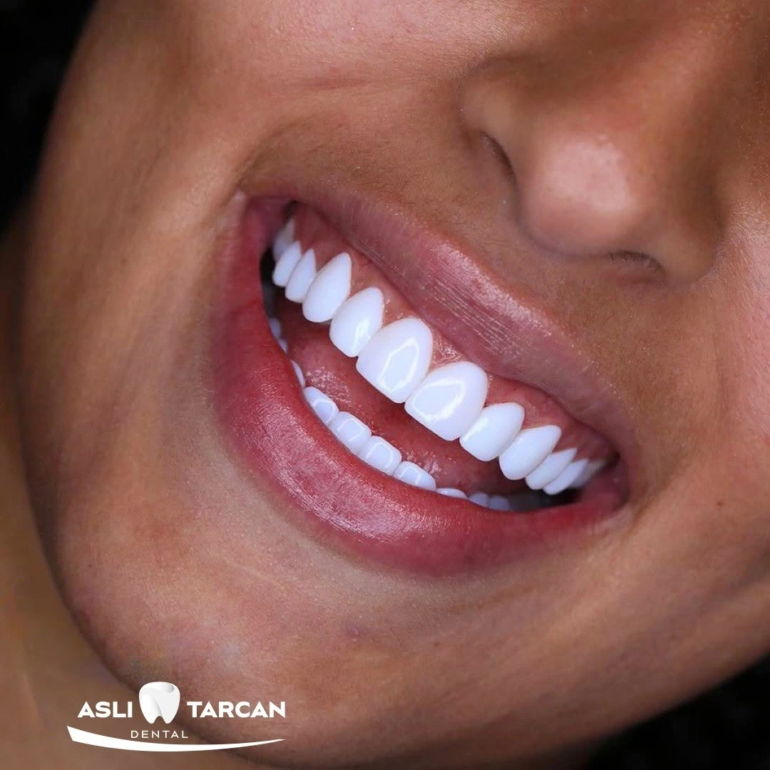 Who Should Avoid Hollywood Smile Treatment