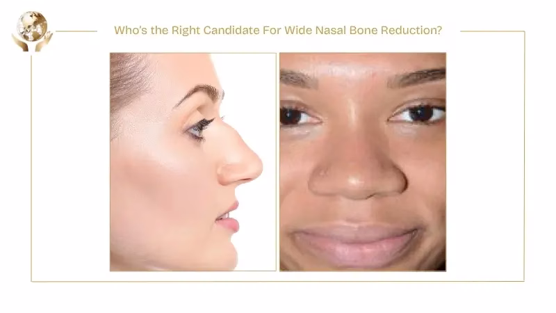 Wide Nasal Bone Reduction: What to Expect Before and After 4 Who’s the Right Candidate For Wide Nasal Bone Reduction