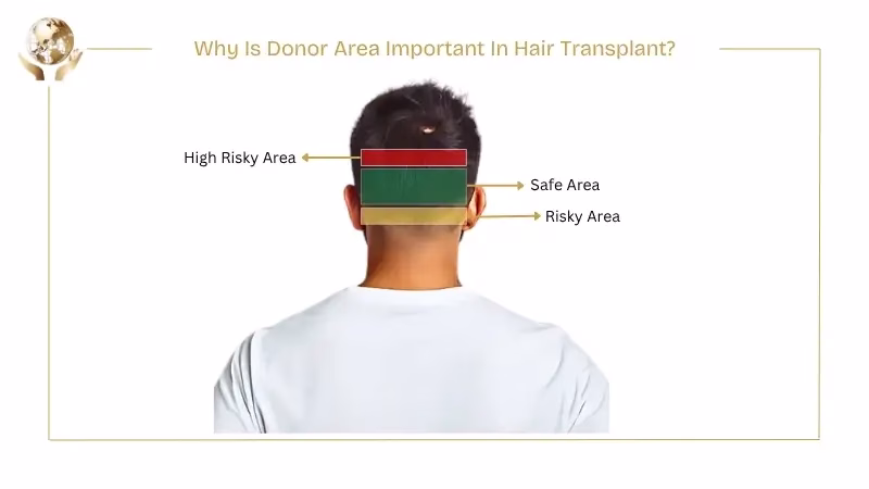 Not Enough Donor Hair For Transplant 2 Why Is Donor Area Important In Hair Transplant