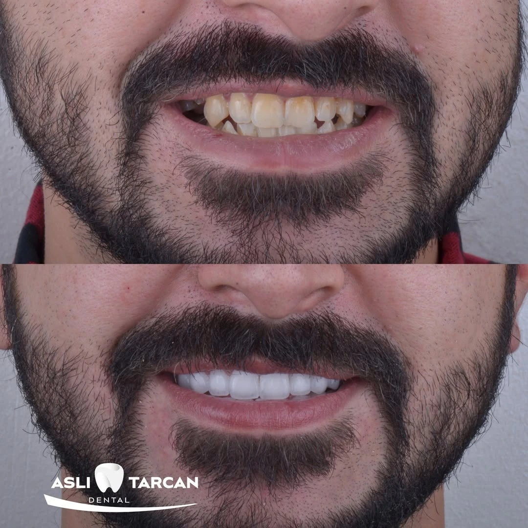 Zirconium Crowns Turkey 8 Your teeth are an important part of how you look and feel. Healthy teeth and a sparkling smile