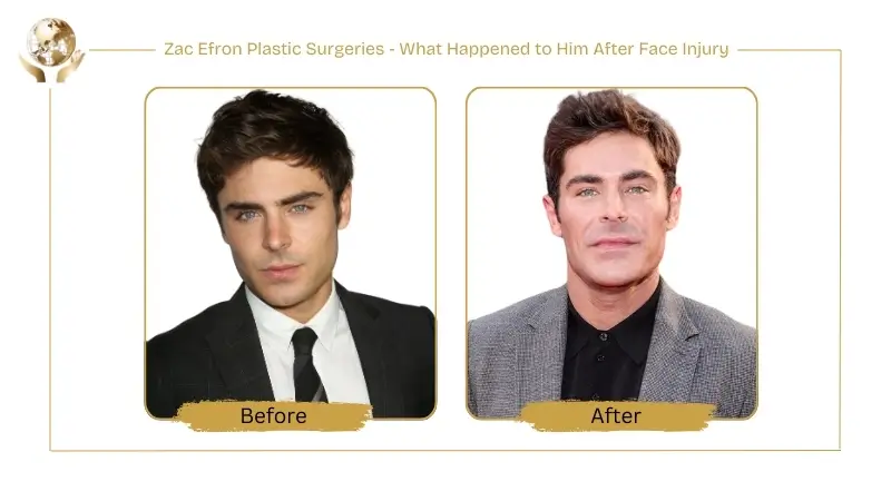 Zac Efron Plastic Surgeries - What Happened to Him After Face Injury 1 Zac Efron Plastic Surgeries - What Happened to Him After Face Injury