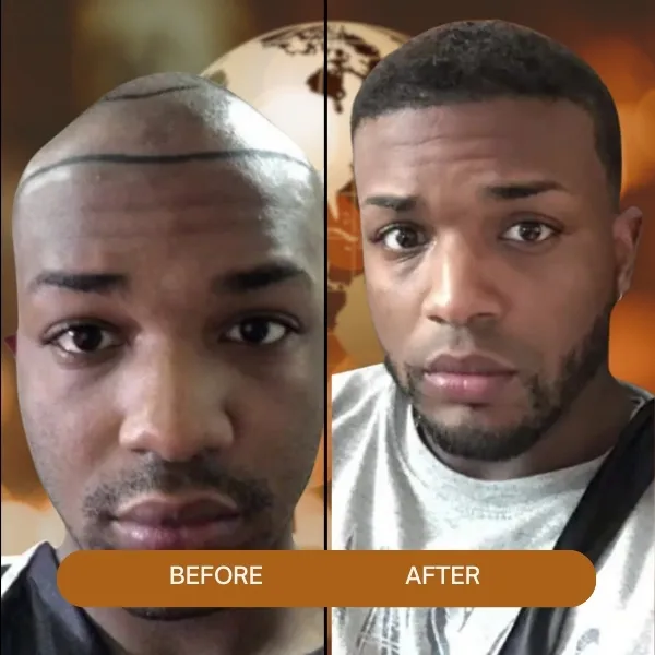 afro hair transplant,Afro Hair Transplant turkey,afro hair transplant in Turkey