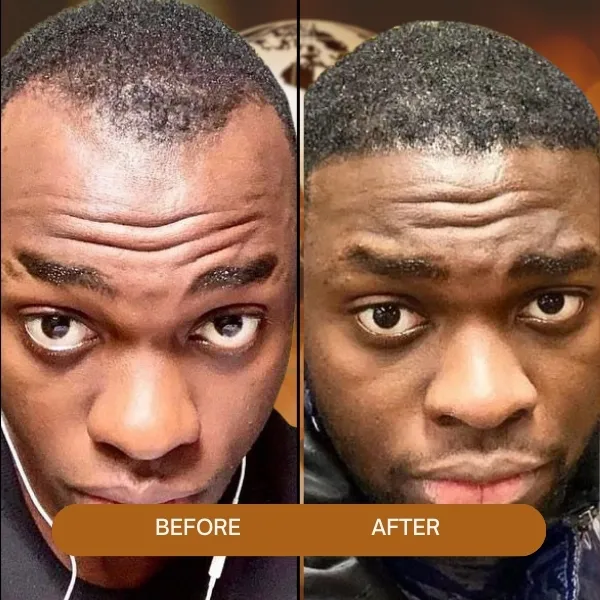 afro hair transplant,Afro Hair Transplant turkey,afro hair transplant in Turkey