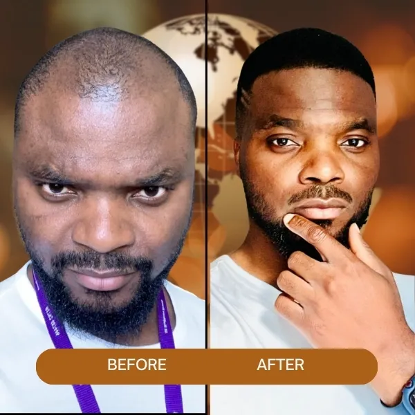 afro hair transplant,Afro Hair Transplant turkey,afro hair transplant in Turkey