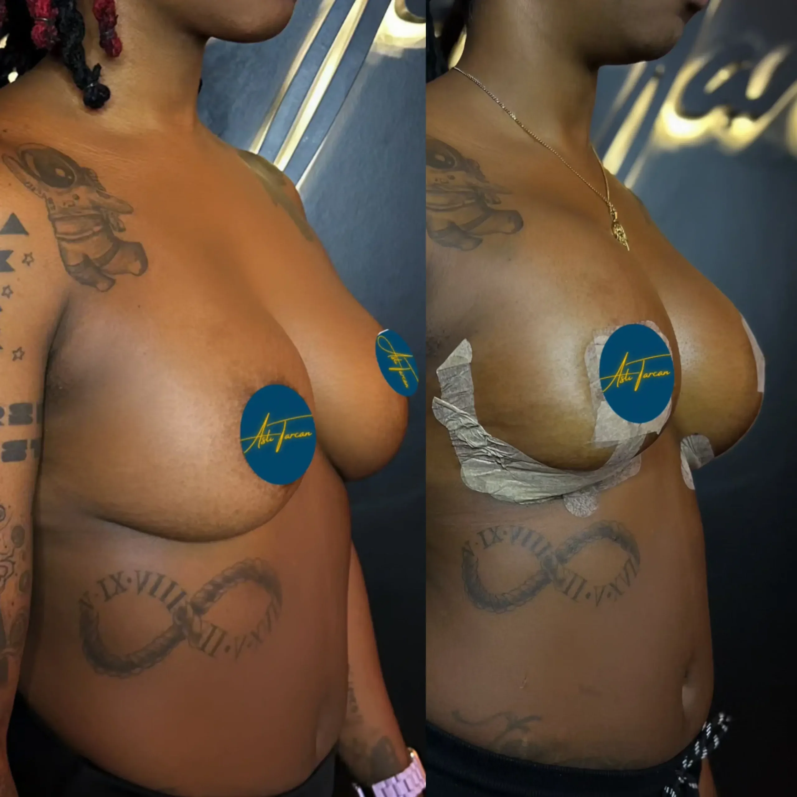 Breast Augmentation Turkey 1 boob augmentation in turkey