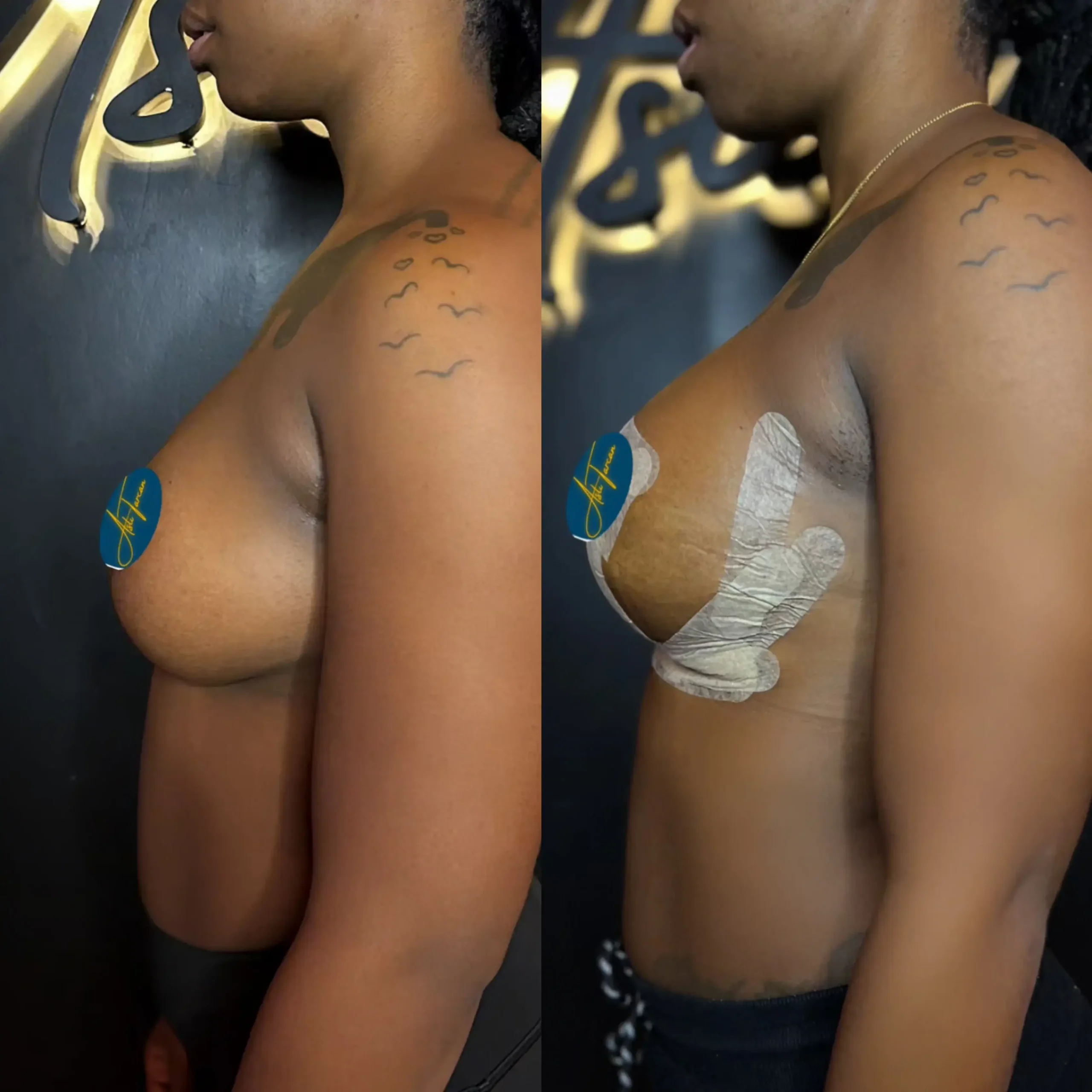 Breast Augmentation Turkey 4 boob augmentation