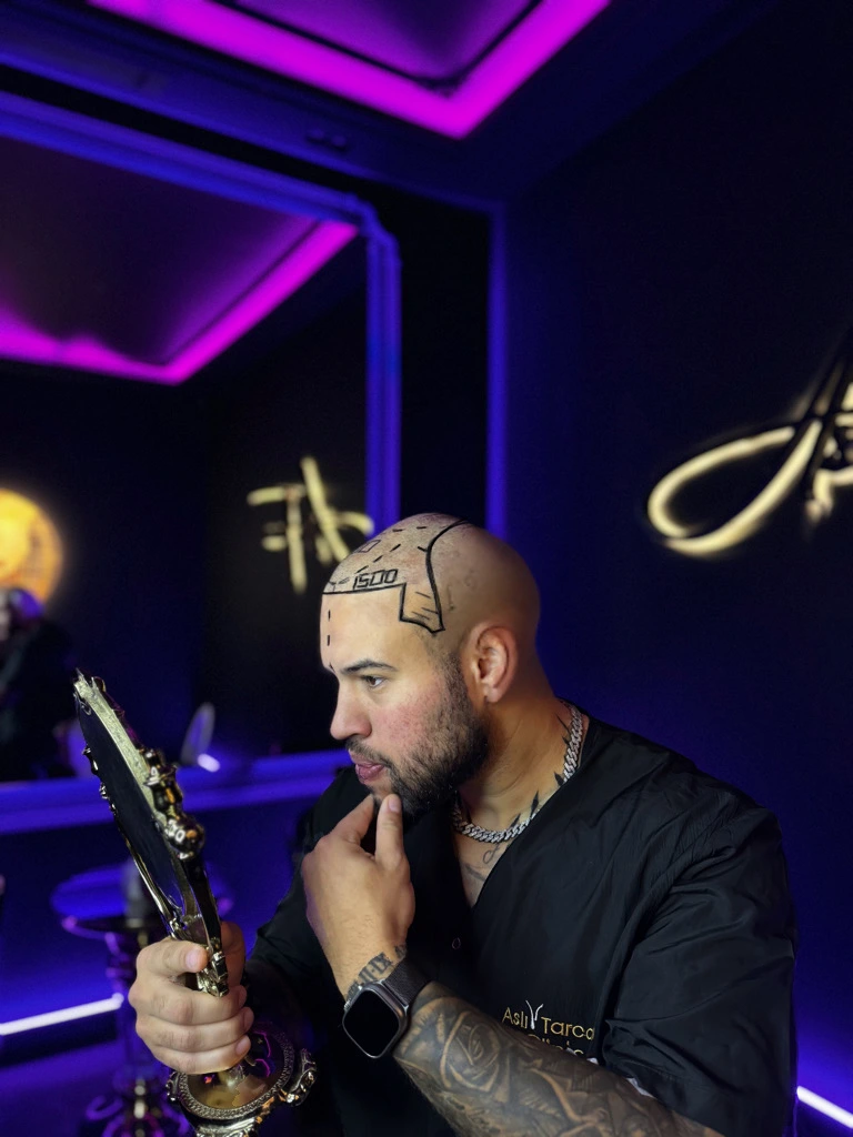 fue hair transplant
