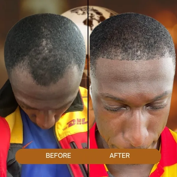 afro hair transplant,Afro Hair Transplant turkey,afro hair transplant in Turkey