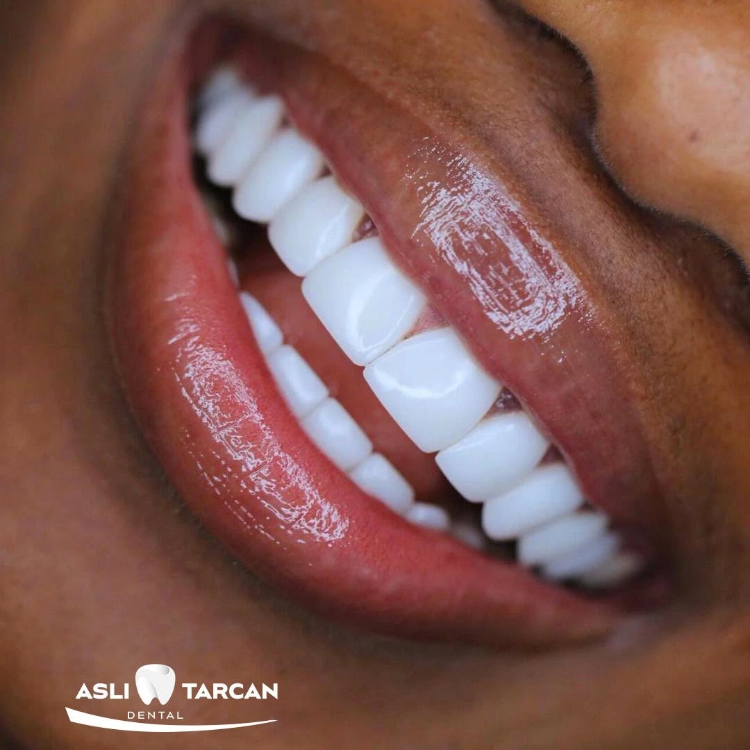 teeth whitening