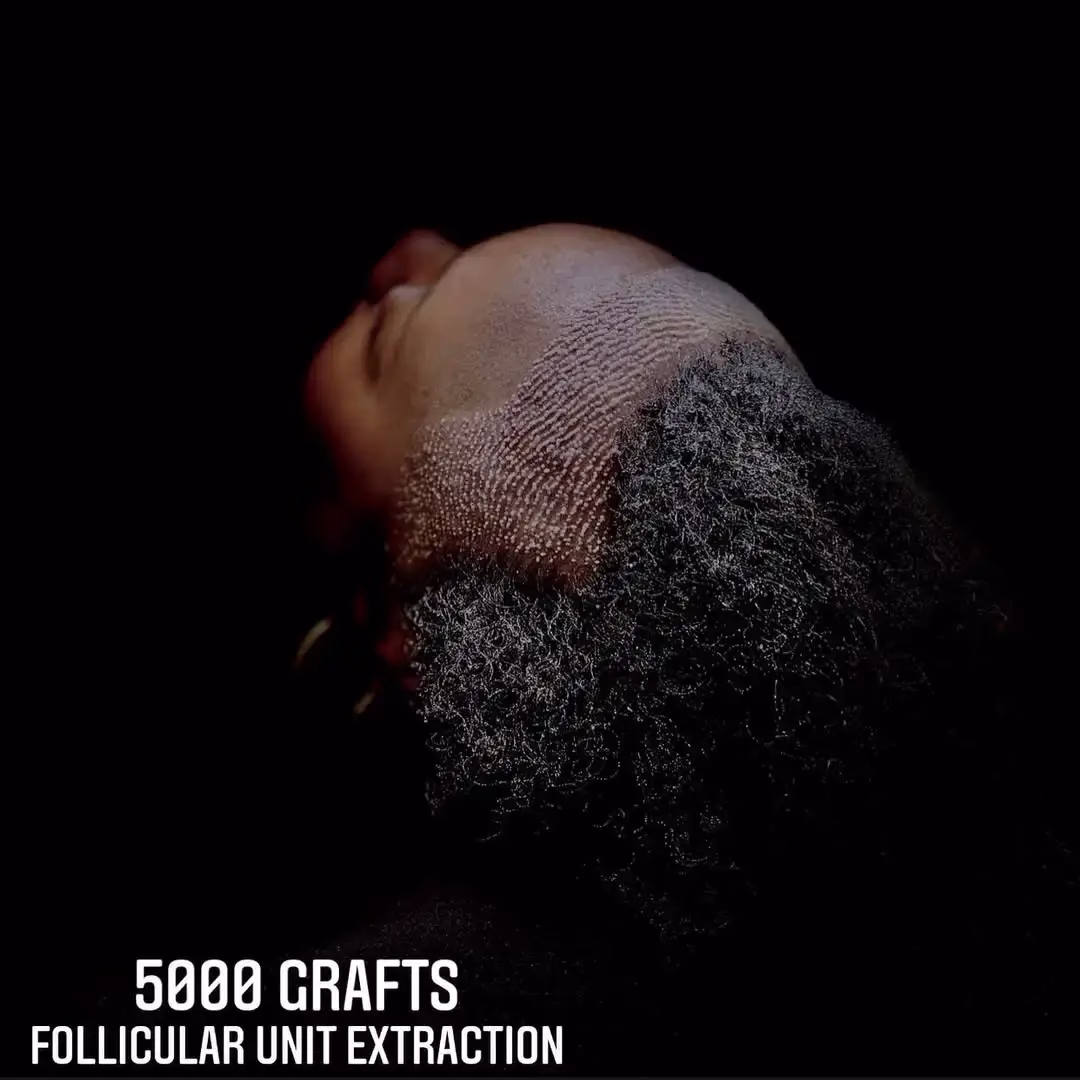 Primer plano del cuero cabelludo de un paciente tras un trasplante capilar con técnica FUE, mostrando la zona receptora densamente implantada con injertos y el cabello rizado natural alrededor, acompañado del texto “5000 grafts – Follicular Unit Extraction”.
