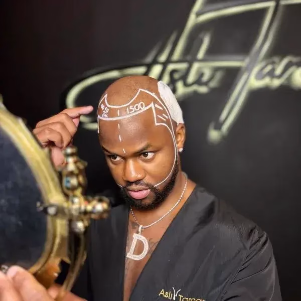Hombre en una clínica capilar mirando un espejo, con marcas de trasplante de cabello dibujadas en el cuero cabelludo y bata de la clínica.