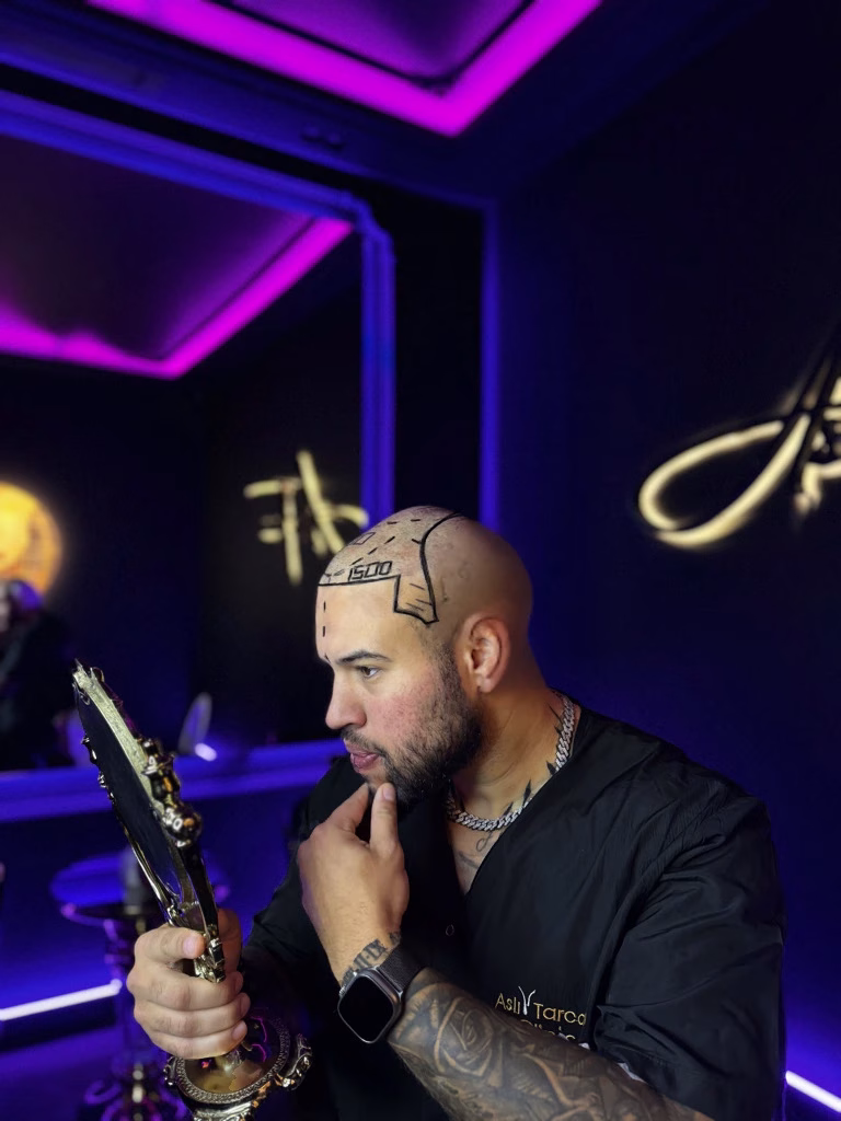 Hombre en una clínica capilar mirando su reflejo en un espejo de mano, con líneas y números marcados en el cuero cabelludo para planificar un procedimiento de injerto capilar; ambiente moderno con luces púrpuras y detalles elegantes.